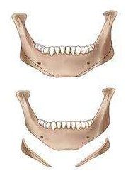 下頜角手術變化圖