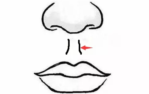 人中缩短术部位展示