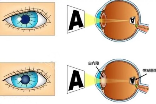白内障和正常眼睛卡通对比一览图