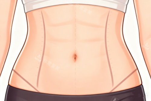 腹壁成型术成果一览