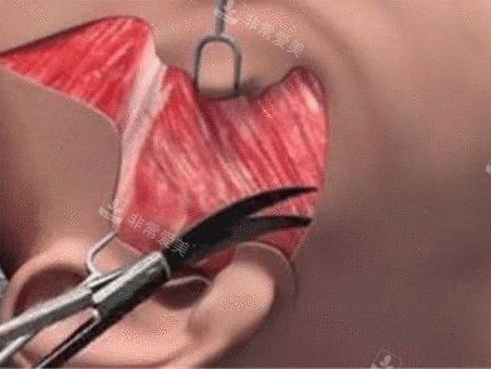 拉皮手術(shù)動(dòng)畫圖