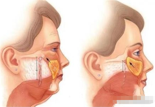 拉皮前后皮膚內(nèi)部以及表面變化圖