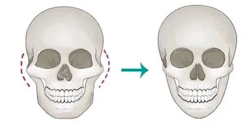 北京张笑天颧骨内推怎么样？术后脸型流畅，妈生感拉满不僵硬