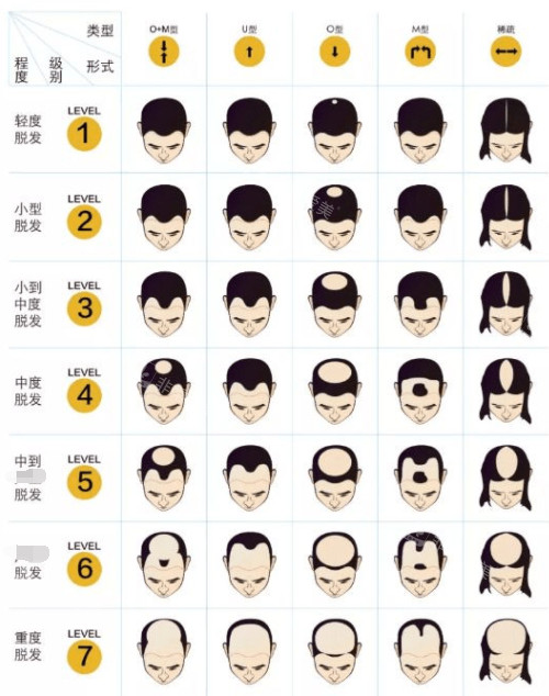 黑米3d纹发不同脱发类型