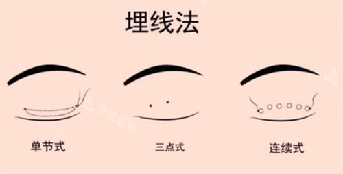 埋線雙眼皮經(jīng)過