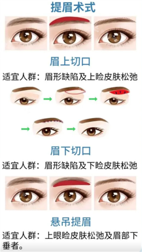 提眉術(shù)式解析