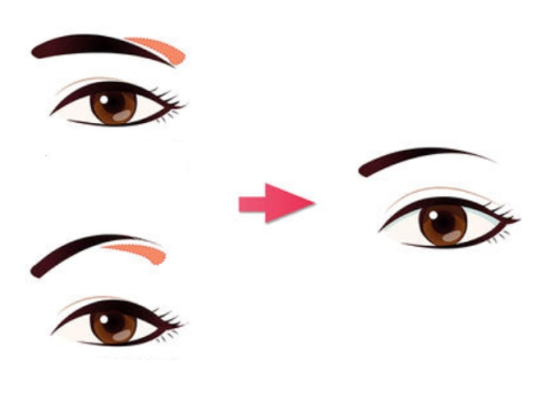 提眉手術(shù)前后對(duì)比圖