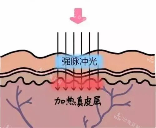 光子嫩膚針對的皮膚層