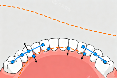 牙齿矫正概念图