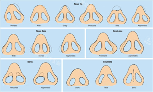 缩小鼻翼的对比图