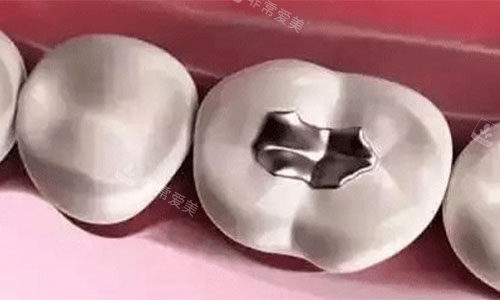 银汞合金的补牙术后