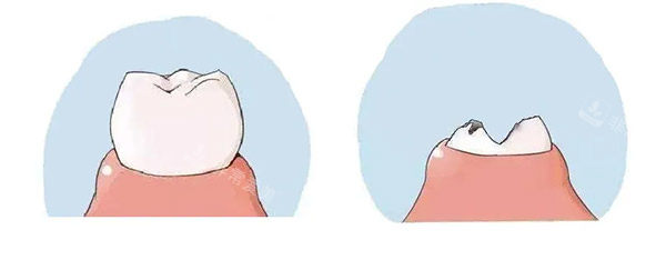 正常牙齿和坏牙对比