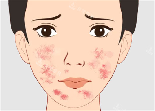 痘印治疗方法
