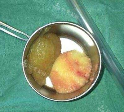 取出的奥美定照片