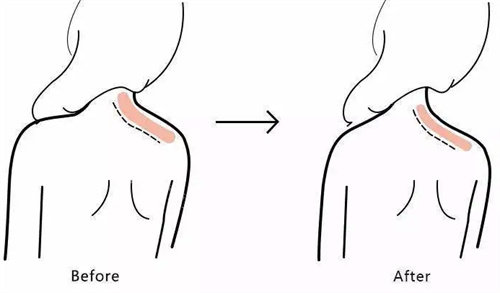 瘦身针注射前后
