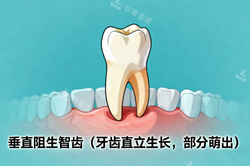 垂直阻生智齿展示