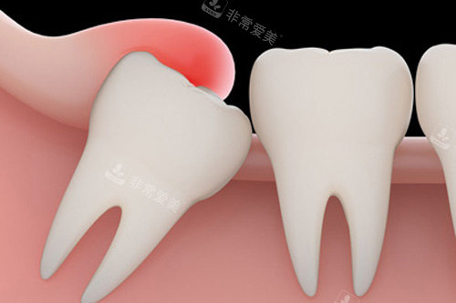 智齿肿胀示意图