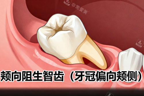 颊向阻生智齿展示图