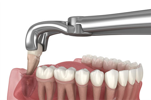 智齿拔出