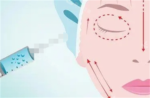 玻尿酸面部填充示意图