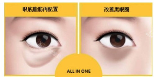 韩国眼底脂肪重排技术靠谱,术后眼底平整,黑眼圈也逐步消失不少!