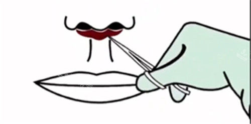 成都人中缩短选哪家医院？王皓民坐诊致臻爱，从挂号到术后护理全流程攻略