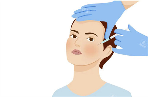 面部注射 面部注射