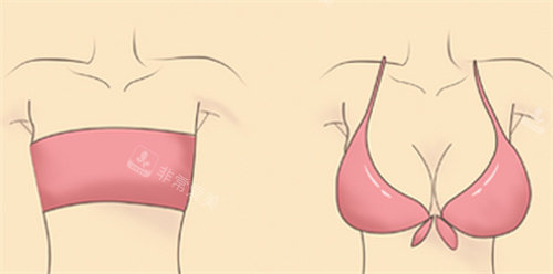 大胸缩小 大胸缩小