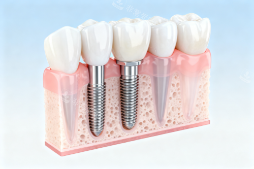 牙齿缺牙修复卡通图展示