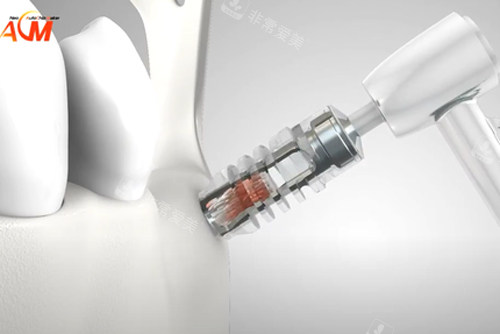 德国ACM种植牙示意图