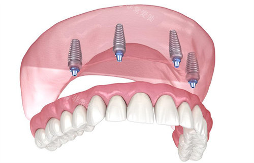 种植牙动画示意图片