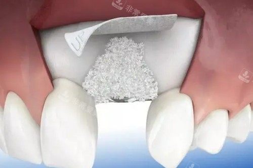 种植牙植骨卡通展示图