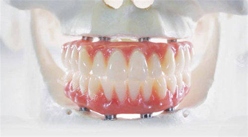 全口种植牙卡通图