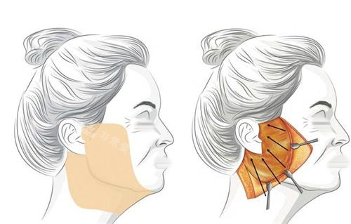 袁强和卢丙仑谁拉皮腻...