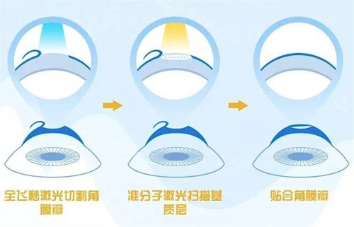 飞秒激光手术过程