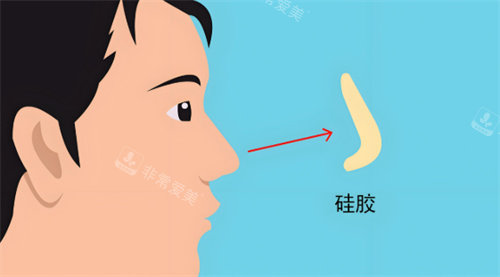 硅胶假体隆鼻