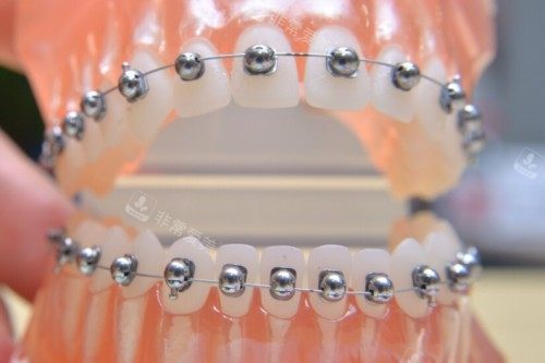 金属矫正模型一览