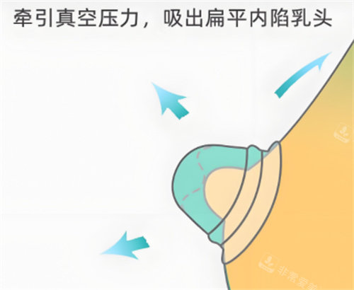 乳头内陷矫正器