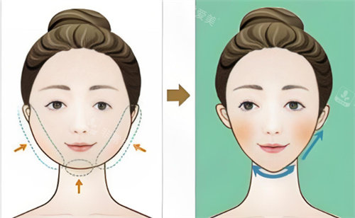 面部吸脂对比卡通