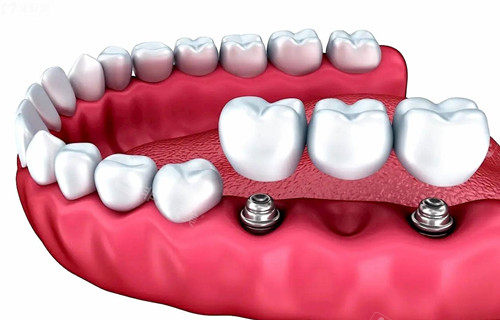 多颗种植牙种植模型示意图