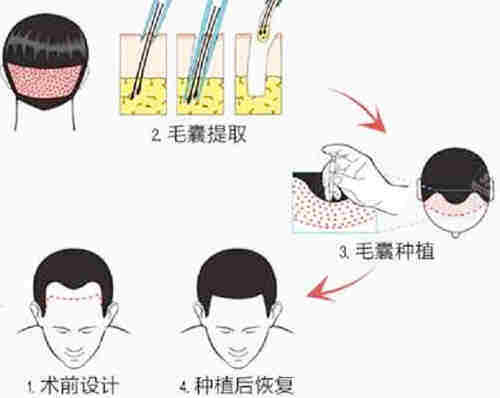 植发过程图解详细