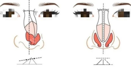 歪鼻修复矫正示意图