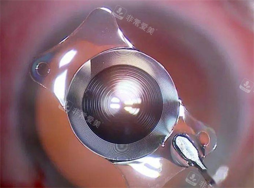 白内障晶体展示