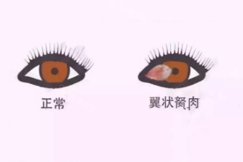 翼状胬肉与正常眼睛对比