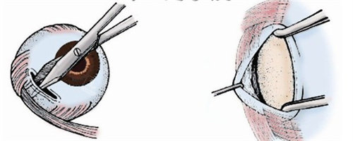 斜视下斜肌手术