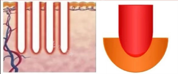 二氧化碳点阵激光