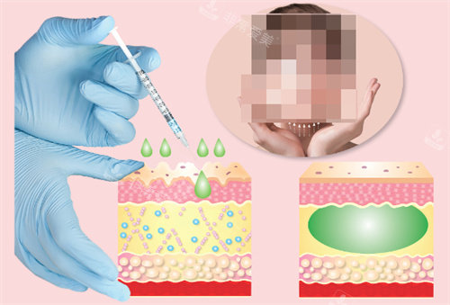 面部注射干细胞 面部注射干细胞