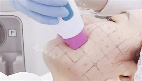 面部热玛吉治疗 面部热玛吉治疗