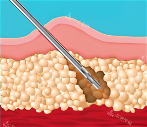 合肥哪个医院抽脂肪好一点？吸脂技术好的医院必须是有这几家！