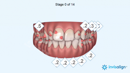 隐适美病例设计